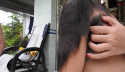 Bé gái “người sói” ở Cà Mau sẽ được chữa bệnh hoàn toàn miễn phí